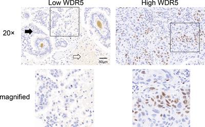 WDR5 is a prognostic biomarker of brain metastasis from non-small cell lung cancer